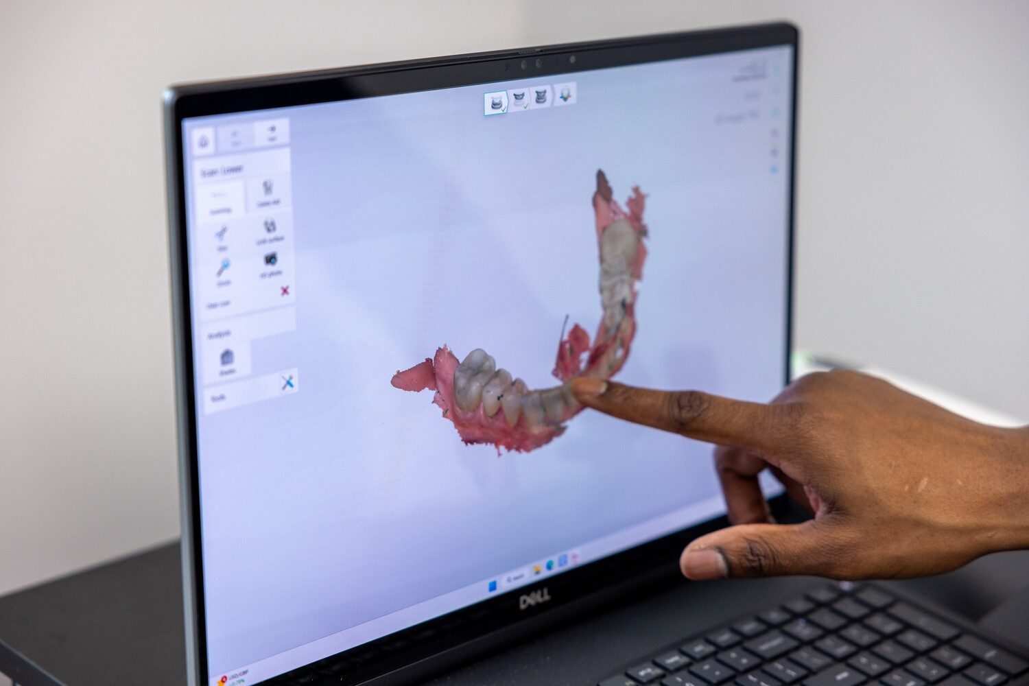 wisdom tooth removal, wisdom tooth extraction, wisdom teeth extraction, impacted wisdom teeth extraction, wisdom teeth pulled, emergency wisdom tooth removal